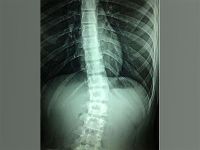 Study finds Spinal fractures in elderly avoidable with simple X-ray method